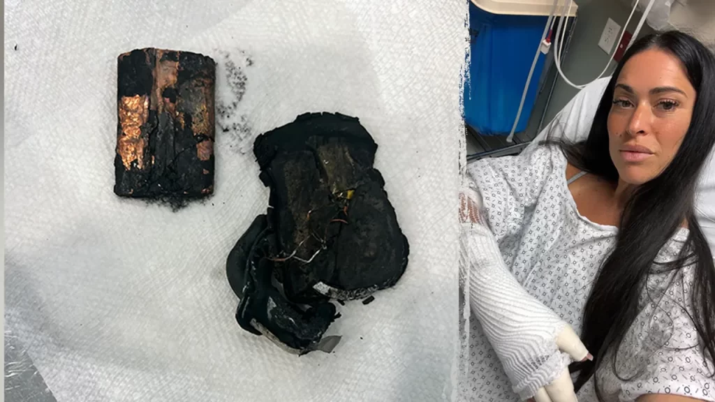 Portable charger explodes in bed, leaves woman with chemical burns